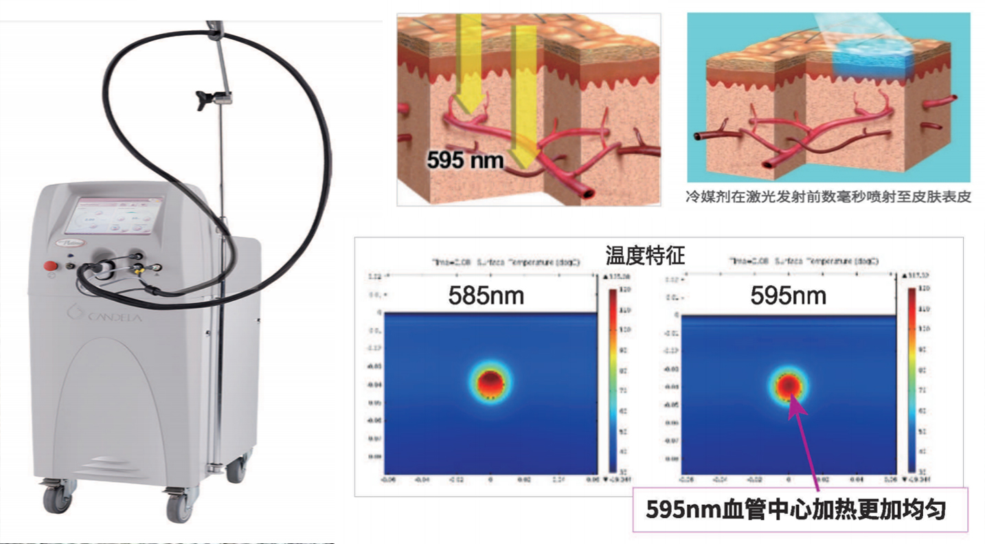 Vbeam595nm脉冲染料激光——鲜红斑“治”的金标准