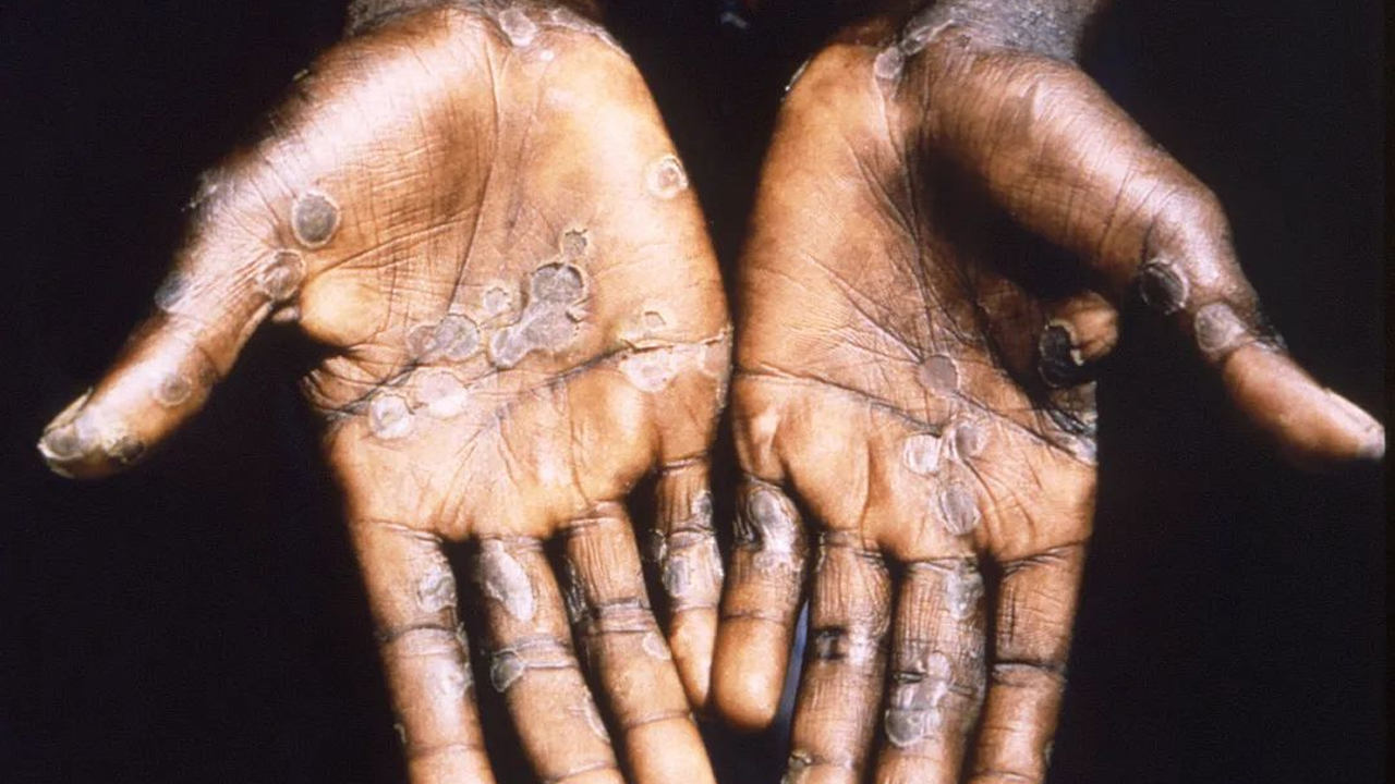 为什么猴痘疫情让科研人员高度警惕