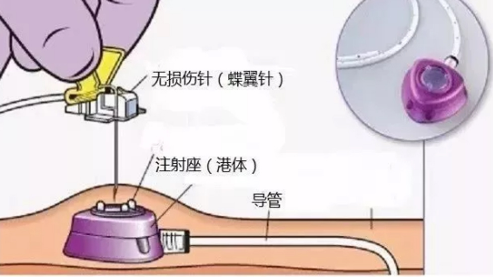 多学科协作破高龄治疗难题，输液港技术启精准医疗新篇--二人麻将指南网
以创新实践守护患者健康