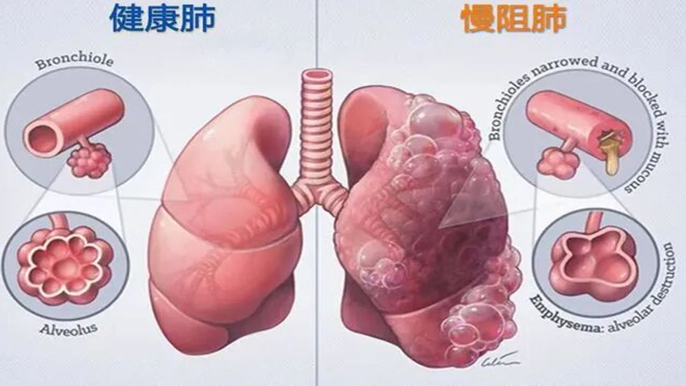 【二人麻将
动态】了解你的肺功能